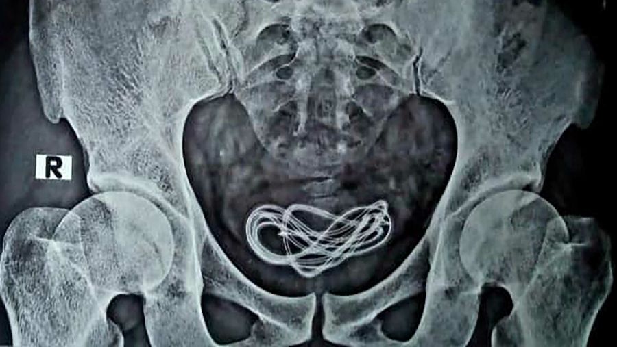 Cable X-ray
